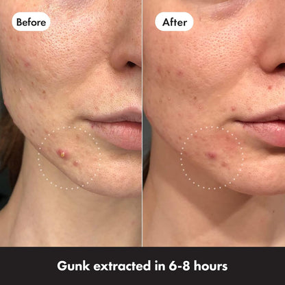 Mighty Patch Invisible+ Spot Patches by Hero Cosmetics, Daytime Acne Treatment, Clear Spot Remover Hydrocolloid Patches, Anti Acne Dots, Spot Treatment Blemish & Pimple Stickers - 39 Pimple Patches