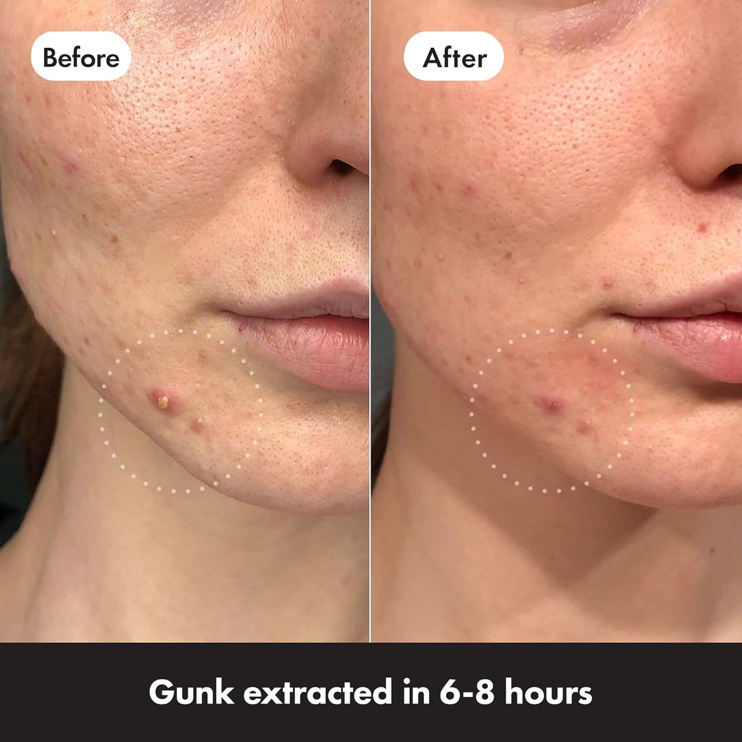 Mighty Patch Invisible+ Spot Patches by Hero Cosmetics, Daytime Acne Treatment, Clear Spot Remover Hydrocolloid Patches, Anti Acne Dots, Spot Treatment Blemish & Pimple Stickers - 78 Pimple Patches