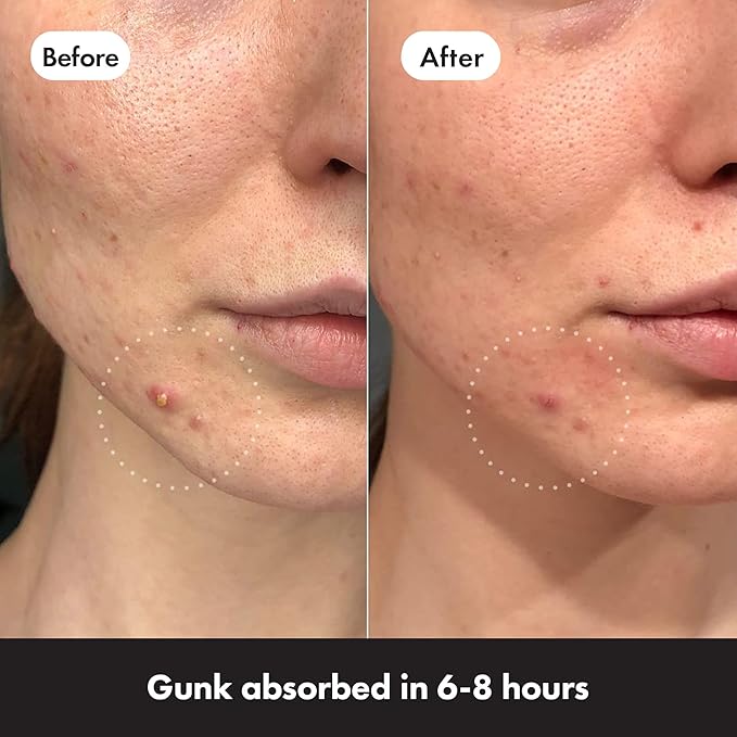 Mighty Patch Original Spot Patches by Hero Cosmetics, Day & Night Time Acne Treatment, Clear Spot Remover Hydrocolloid Patches, Anti Acne Dots, Spot Treatment Pimple Stickers - 36 Patches